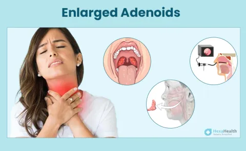 Adenoid: Symptoms, Causes, and Treatment