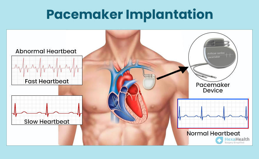 Pacemaker Implantation: Symptoms, Causes, and Treatment