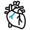 Angioplasty