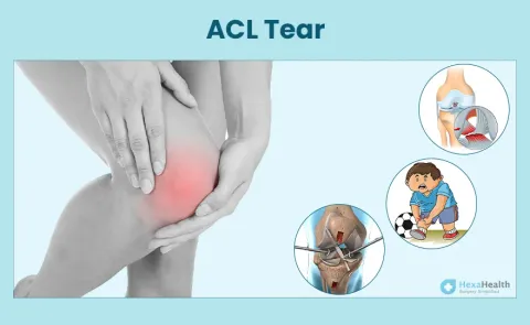 ACL Tear: Symptoms, Causes, and Treatment