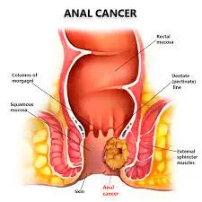 Anal Cancer: Symptoms, Causes, and Treatment