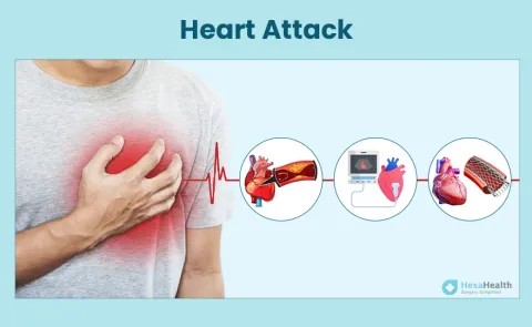 Cardiac Arrest/Heart Attack: Symptoms, Causes, and Treatment