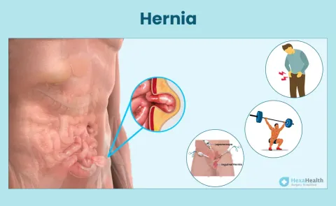 Hernia: Symptoms, Causes, and Treatment
