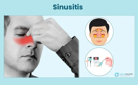 Sinusitis: Symptoms, Causes, and Treatment