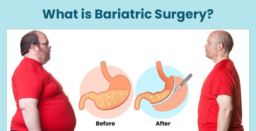 Bariatric Surgery: Overview, Benefits, and Recovery