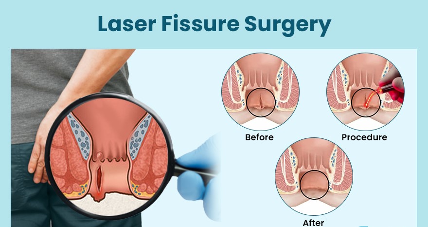 Fissure Laser Surgery - Procedure, Treatment, Recovery Time