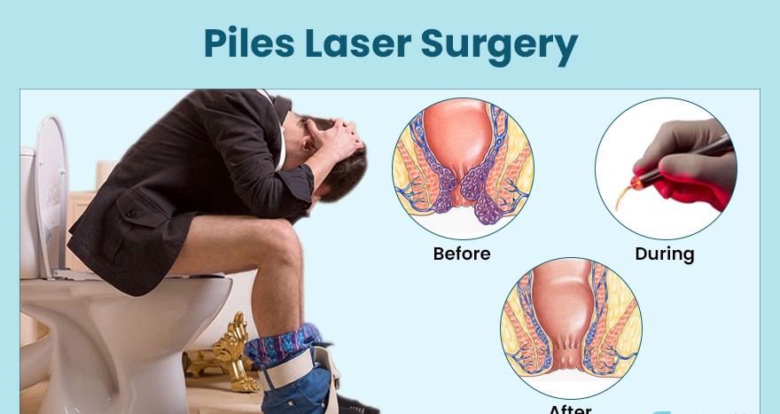 Laser Treatment for Piles - Surgery, Operation and Side Effects
