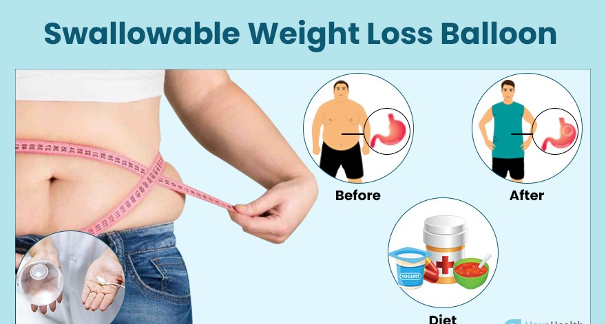 Swallowable Gastric Pill Balloon for Weight Loss in India
