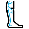 Varicose Vein